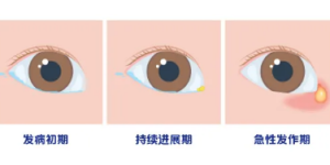 合肥爱尔眼科：先天性泪道阻塞该怎么治疗？
